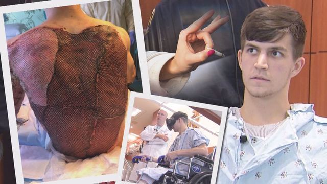 Flick of a cigarette engulfs young biker in flames; now recovering in virtual reality- We all had this happen at one time or&nbsp;another.